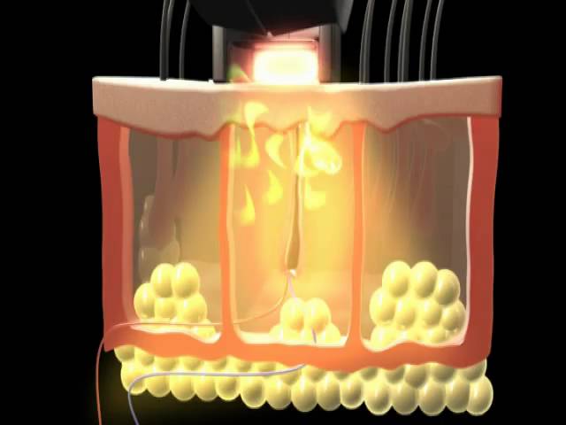 Элос-омоложение