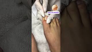 ✨🦶 Swollen Toenail Edge? Let Us Care for You💕💕 #nails #nailart #cleannails #nailcareroutine