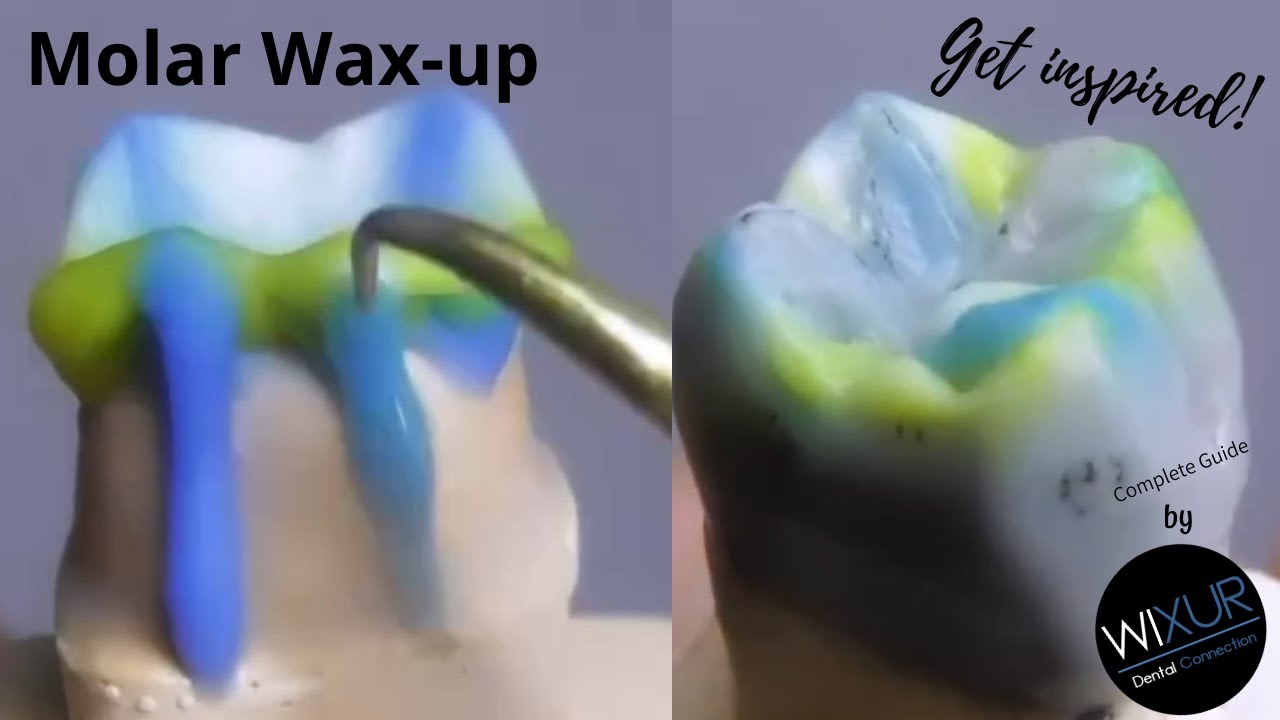 Molar Wax up