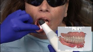 Full-Arch Intraoral Scanning F-Tx Prosthesis & Abutment Workflows