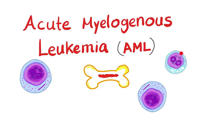 Acute Myeloid Leukemia (AML) | Auer Rods | Myeloperoxidase Positive - Hematology - DayDayNews
