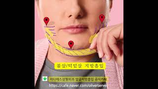 이중턱을 만드는 턱밑살/ 얼굴살 지방흡입 중점진료 의료기관은? #지디에스성형외과 #지디에스 #강남역성형외과