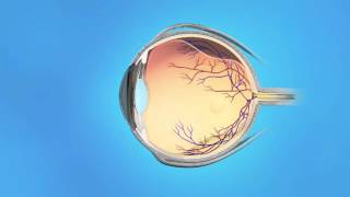 Vitreo-Macular Adhesion (VMA) or Vitreo-Macular Traction (VMT)