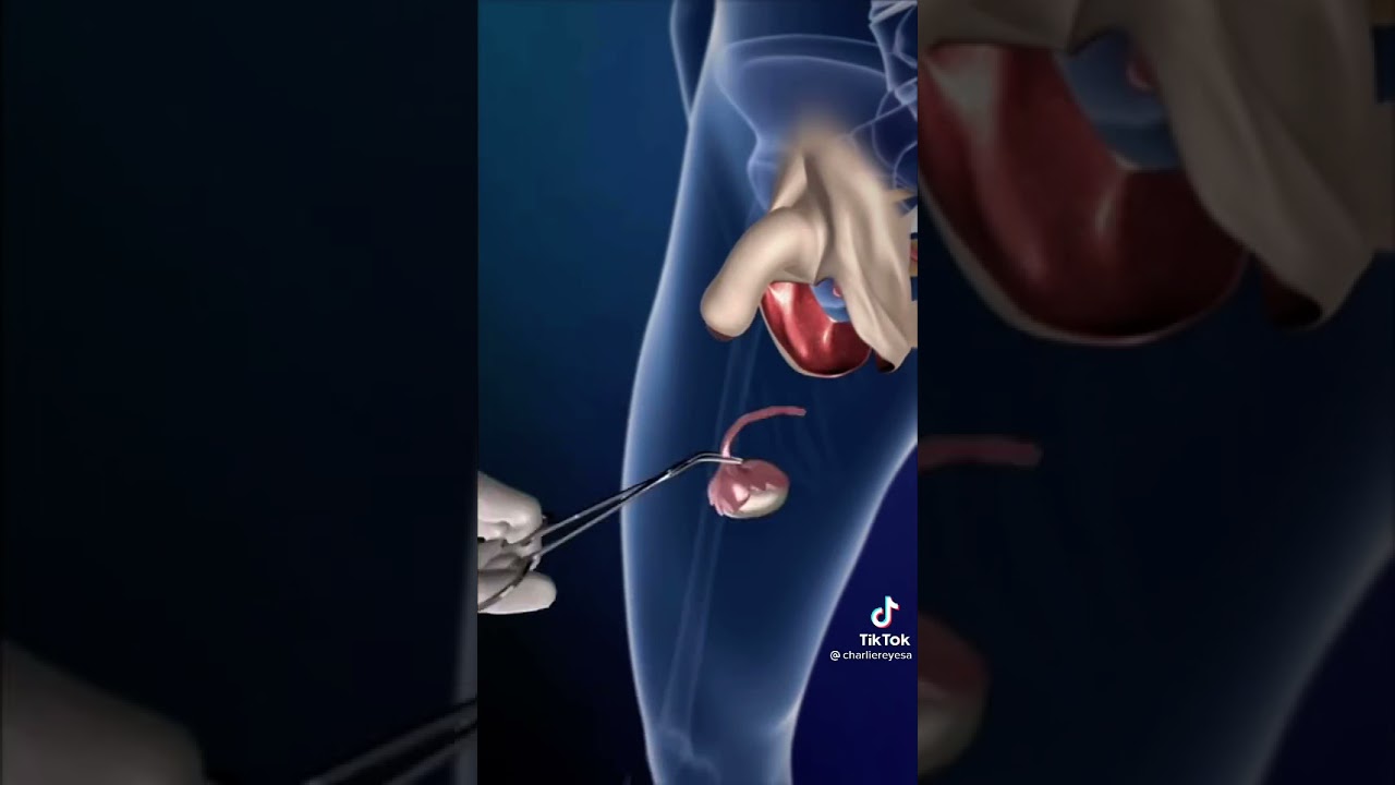 cirugía para cambiar de sexo🤪😂