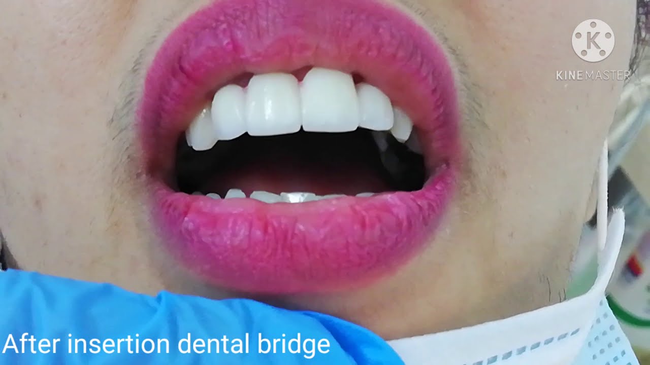 Inserting Dental Zirconia Bridge in the Upper Frontal Teeth Dental Clinic