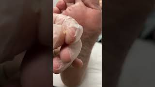 Feel The Relief! Watch How This Aussie Podiatrist Tackles A Stubborn Forefoot Corn.