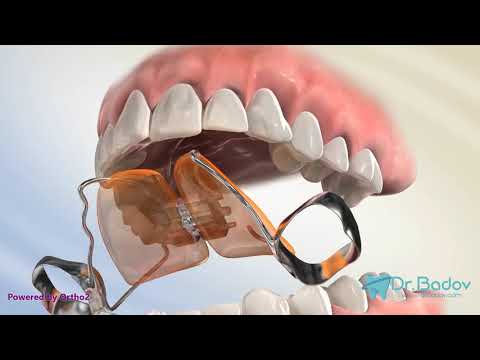 #ортодонт #брекети #ортодонтия Кръстосана захапка при дъвкателните зъби- какво е и как се лекува?