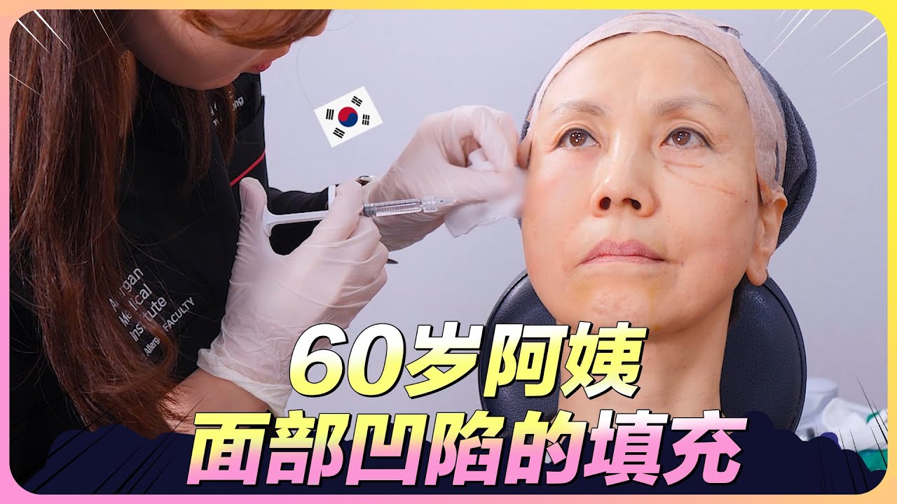 60的韩国阿姨面部凹陷怎么办？看医生如何给您变魔术！ (feat:特秀恩碧明洞店）