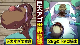 【実話】巨大アゴの世界記録。デカすぎて窒息し...2kg超えの下アゴを摘出。