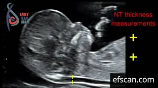 Nuchal translucency (NT) thickness measurement: for Early Fetal Scan Conference 2019