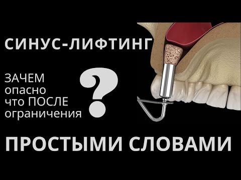 Синус лифтинг. Открытый и закрытый. После синус лифтинга