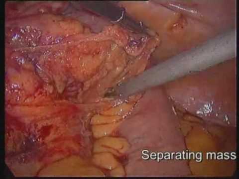 Gastrointestinal Stromal Tumor (GIST)operation