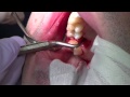 Physics Forceps Upper Molar Tooth Extraction, Cytoplast Barrier & Grafting