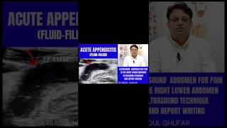 #ultrasound #appendicitis #appendicularskeleton #appendixcarry  #video #abdomen #radiology #foryou