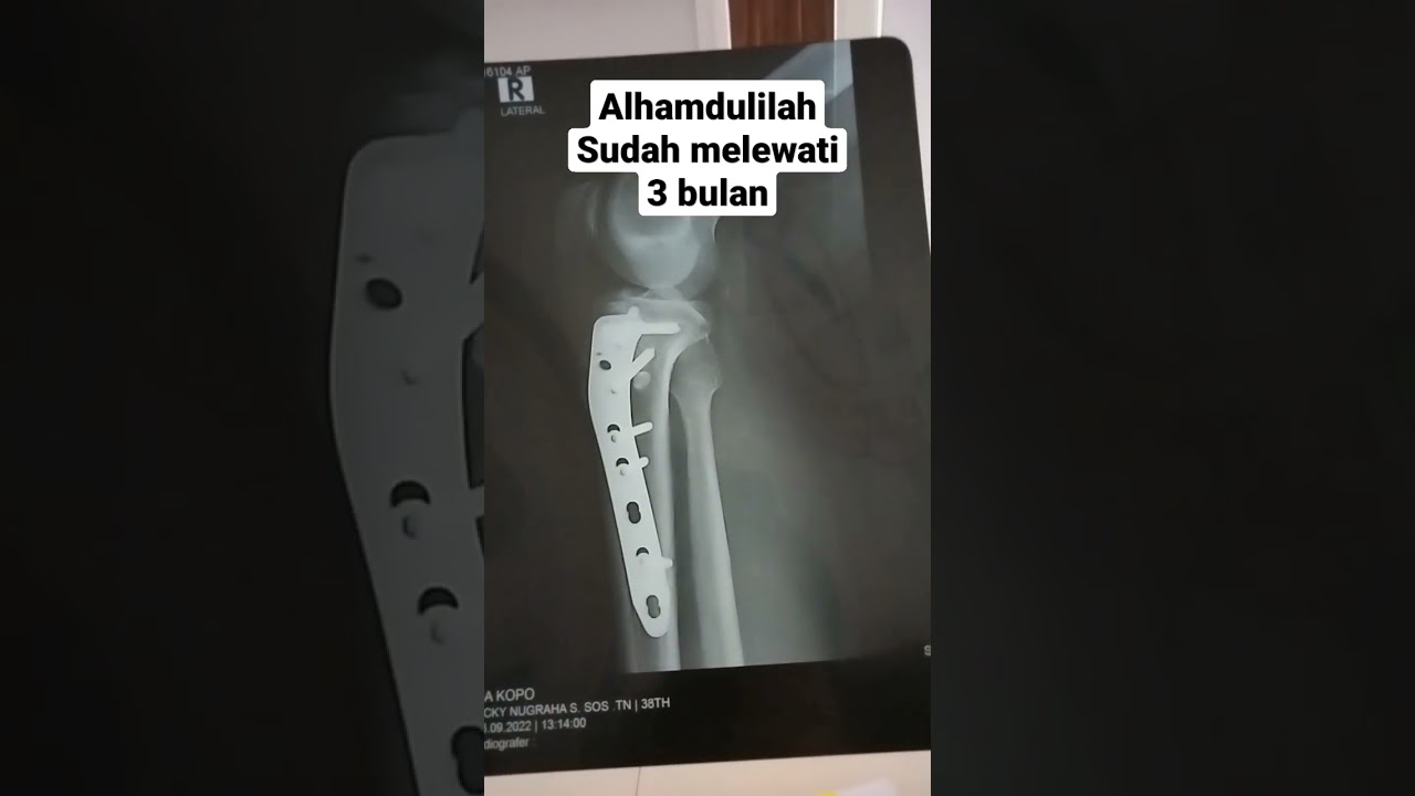operasi patah tulang pasang pen 