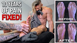 The Worst Pain Fixing 10 Years Of Flat Feet Bunions Amazing Results Lex Fitness