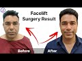 Facelift Surgery In Chandigarh | Cost OF facelift Surgery In Chandigarh | Zenith Clinic