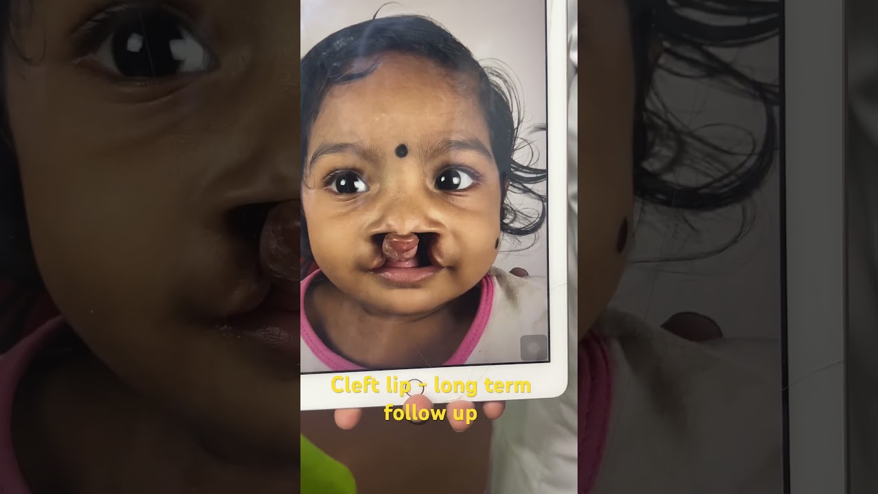 Два года спустя после операции по поводу широкой двусторонней расщелины губы и неба, проведенной ...
