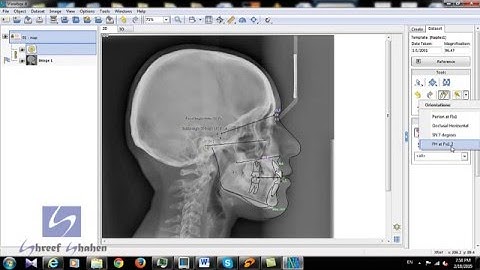 Digital cephalometric tracing