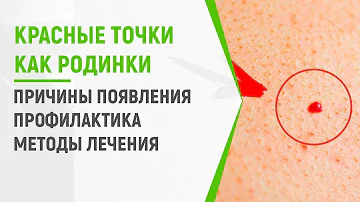 Красные точки на теле как родинки