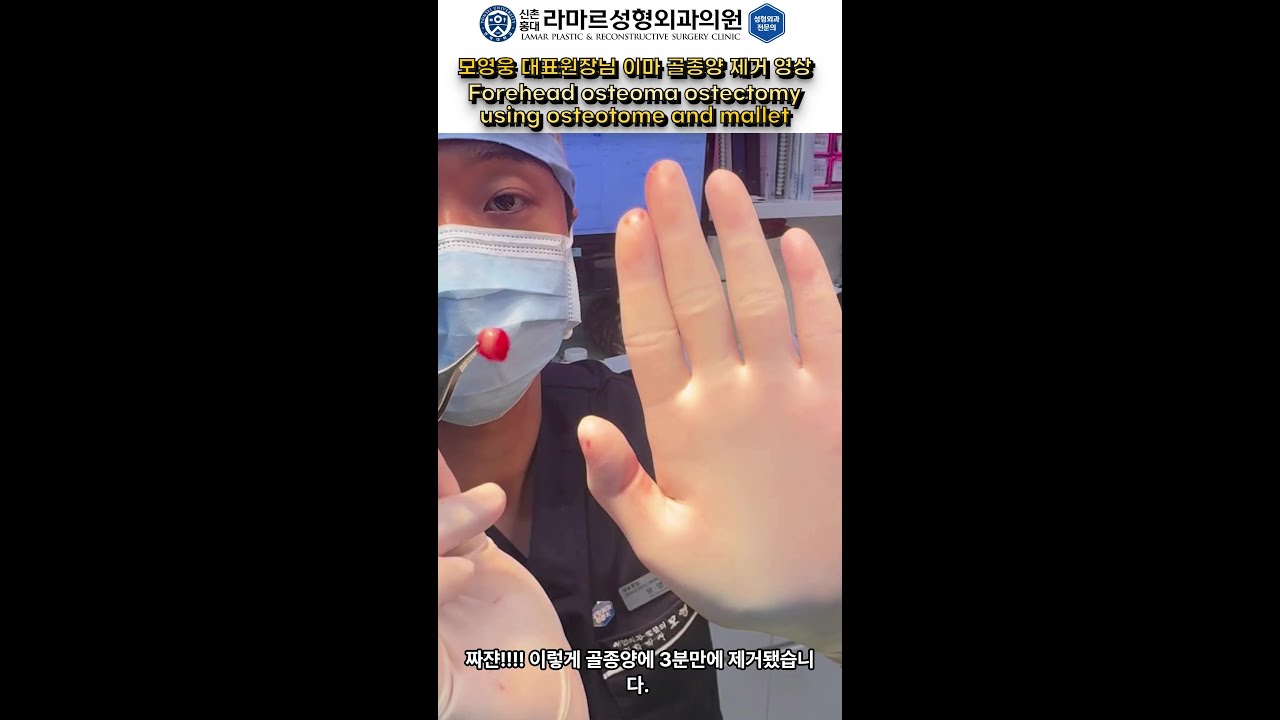 모영웅 원장님 이마 골종제거 영상 (Forehead osteoma removal using osteotome and mallet)