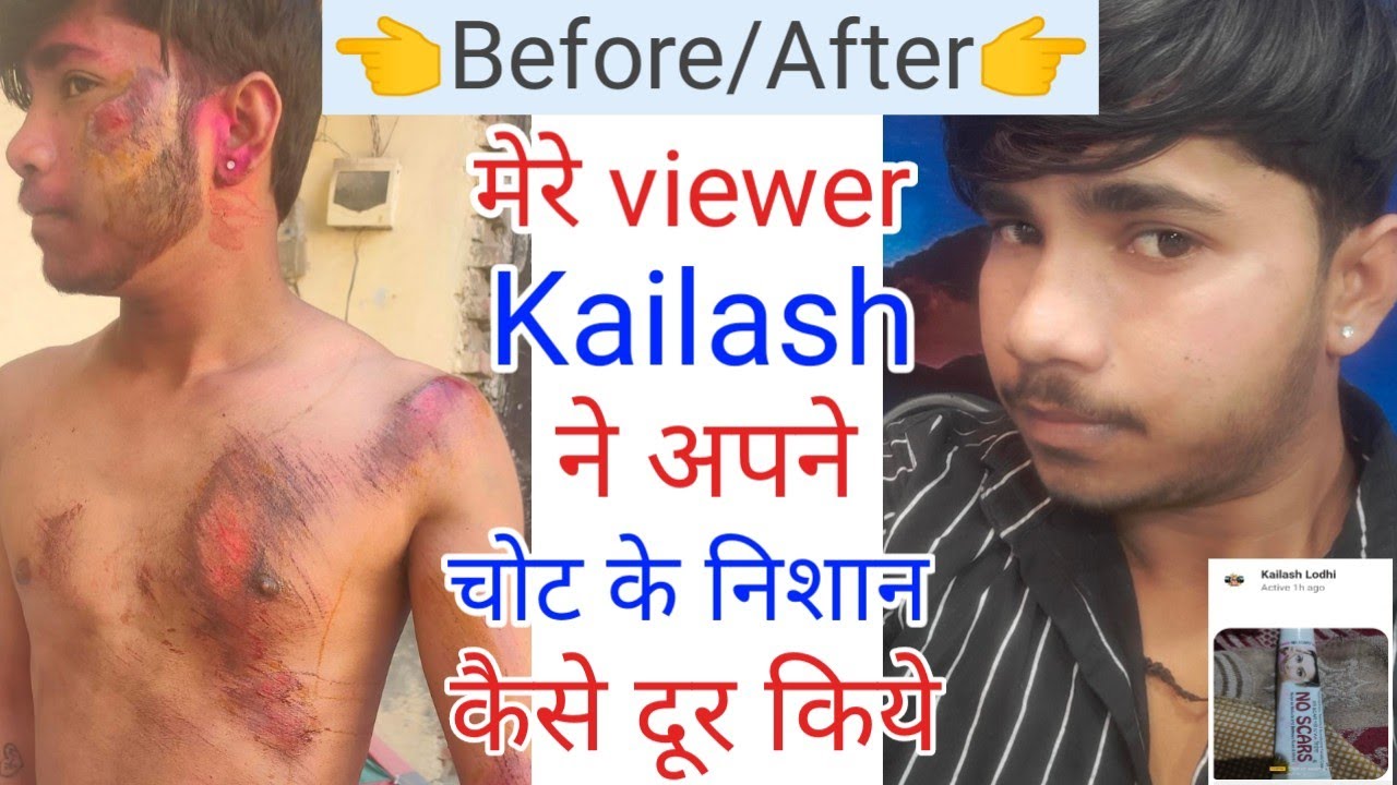 Chot ke nishan kaise mitaye. Chot ke nishan hatane ki cream. Chot ke daag hatane ke upay