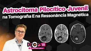 Astrocitoma Pilocítico Juvenil Como Reconhecer Na Tc E Rm? I Você Radiologista