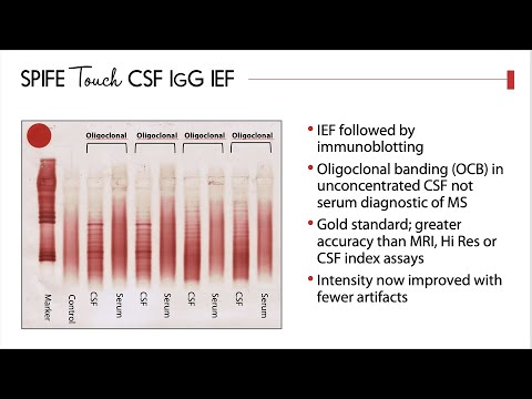 Oligoclonal Banding Assay; Diagnosing Multiple Sclerosis