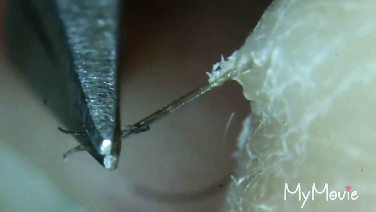 Don T Wait Plucking Ingrown Hairs All Original Clips Youtube