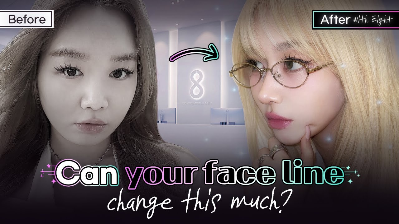 🎇Korean Side Profile Transformation | Real Rhinoplasty & Chin Liposuction Story