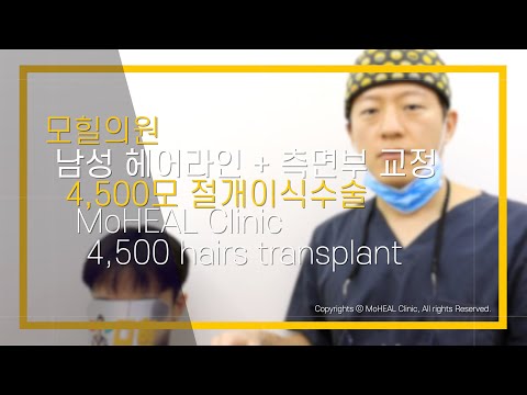 [모힐TV] 4,500모 모발이식으로 넓은 이마와 M자 탈모 교정! 놀랍도록 비교되는 수술전후 공개
