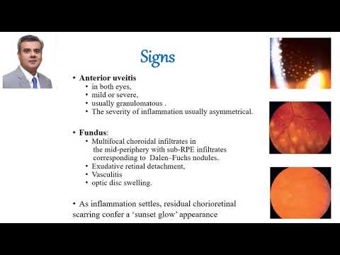 Lecture on Sympathetic Ophthalmia by Dr  Hussain Ahmad Khaqan