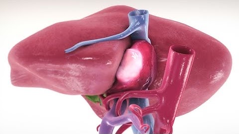 Extended left hepatectomy with caval resection