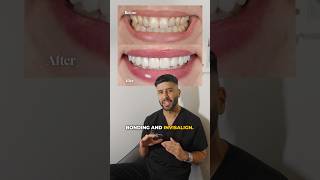 Dr. Sonnie smile makeover 👏 #compositebonding #dentist #veneers