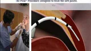 Pillar Procedure - Stop Snoring and Sleep Better screenshot 2