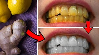 تبييض الأسنان في المنزل | وصفة فعالة لازالة اصفرار الأسنان نهائيا
