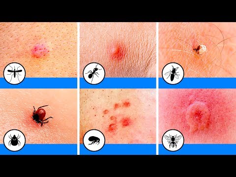 Vídeo: Diferencia Entre Picaduras De Mosquitos Y Chinches