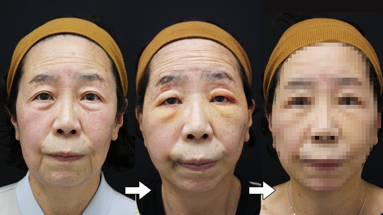 フェイスリフト&脂肪吸引】手術〜7日間のダウンタイム密着【推しのため