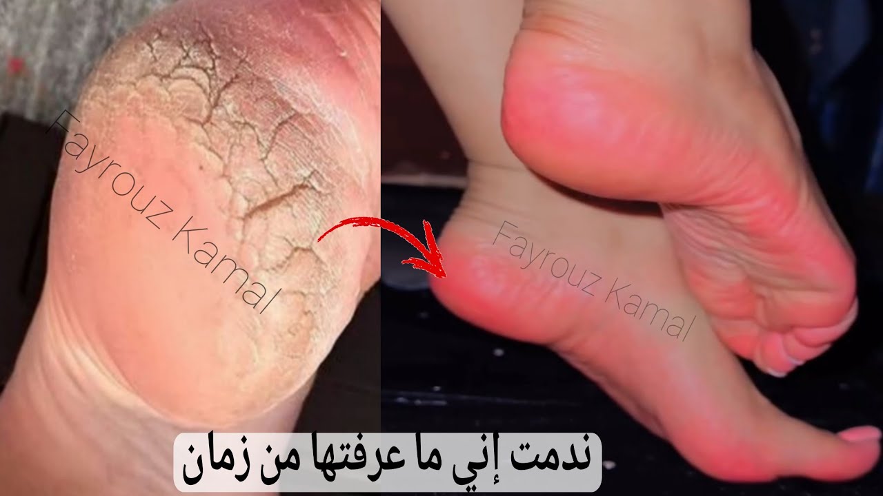 معلقة ملح‼️وقولي وداعًا لتشققات وخشونة القدمين! تقشير وتبييض وترطيب وبياض كالثلج.