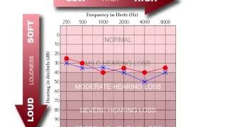 How to Read an Audiogram