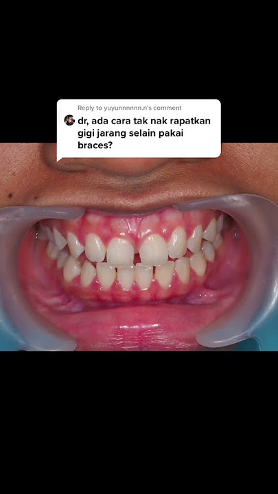 Close Teeth Gap Without Braces | Rapatkan Gigi Jarang Selain Braces