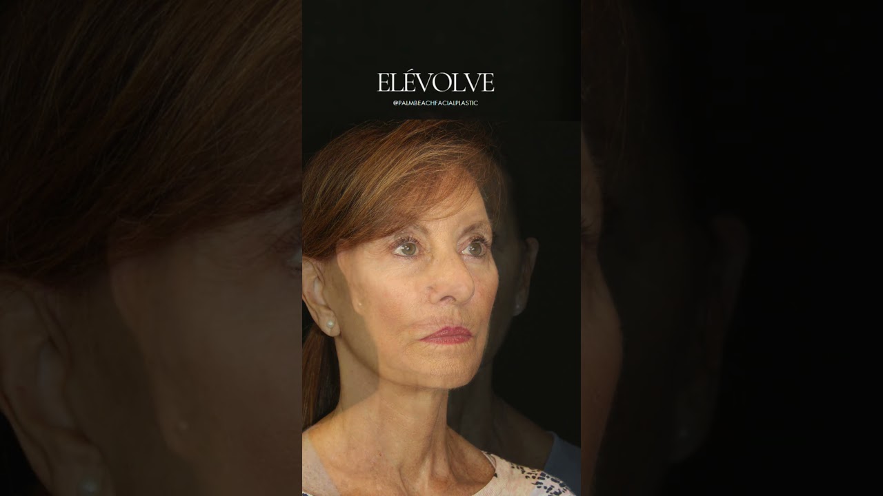 Elevate your beauty to new heights with our Elévolve procedure!