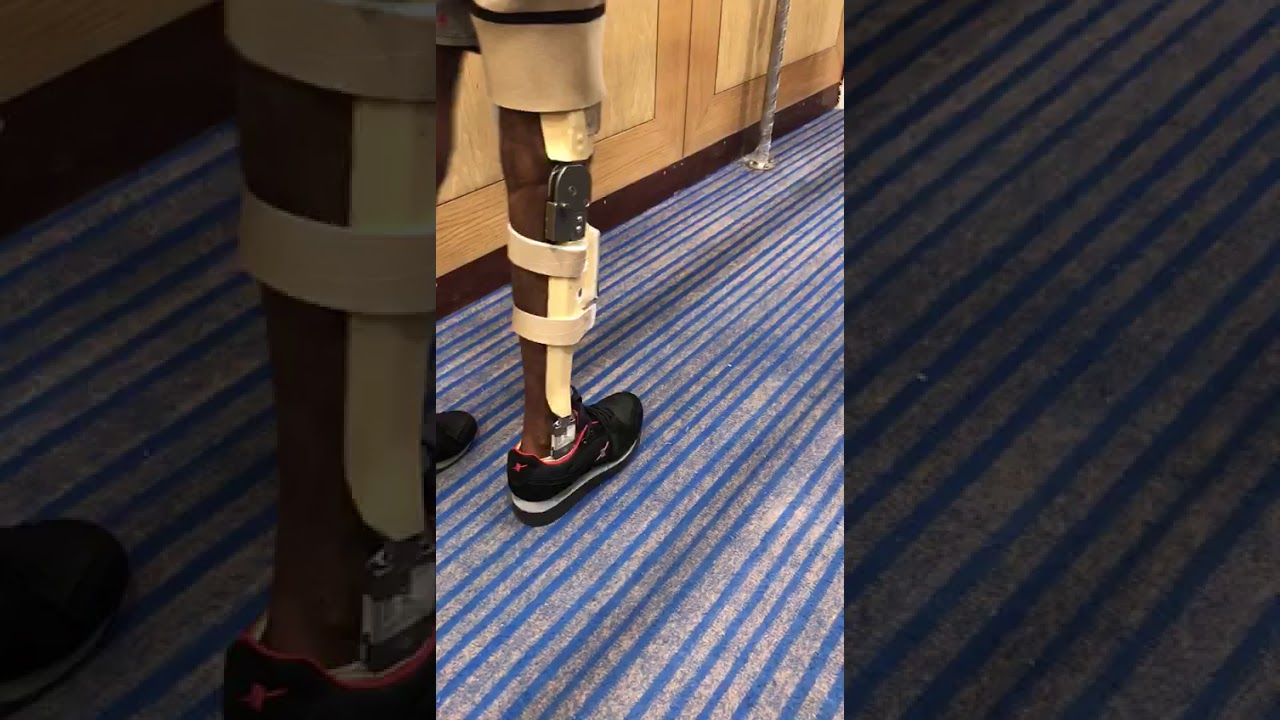 Stance Control Electronic Automatic Kafo Joint Polio Spinal Cord Injury Knee Buckling