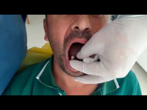 diş çekimi (3 )diş