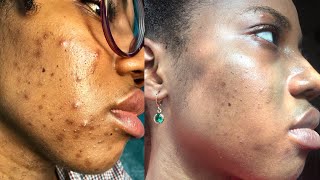 How I got rid of my acne 2022