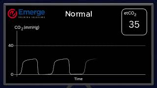 Waveform Capnography - Normal Waveform