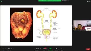 មេរៀនពេទ្យ Adenome prostatique ​Dr. Choeu Bunsy CPD 18062023