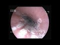 CMV/HSV Esophagitis | Endoscopy | #esophagitis  #cmvesophagitis #esophagusdiesease