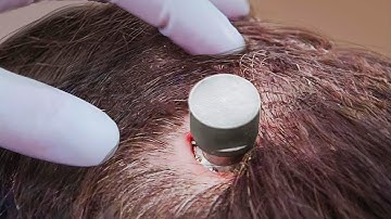 The Promising Future of Brain Computer Interfaces