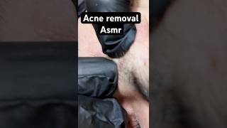 Most Satisfying Acne Clearing ASMR 🤯✨ #shorts
